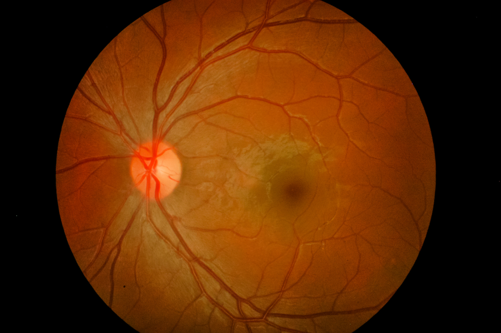 Age-Related Macular Degeneration: Factors Which Contribute to its Development