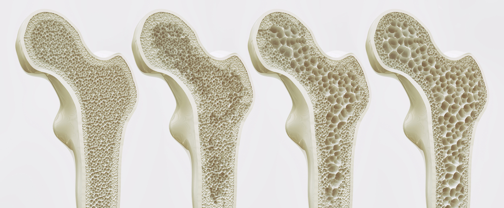 Osteoporose: Strategien zum Erhalt der Knochengesundheit